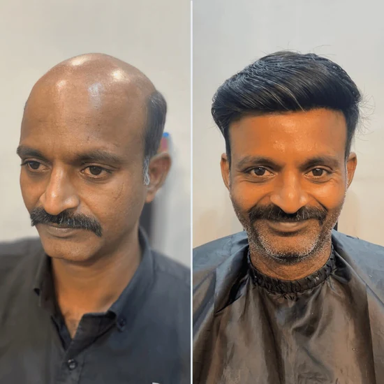 A Topee client before and after a hair system fitting
