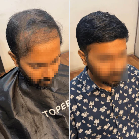 A Topee client before and after a hair system fitting