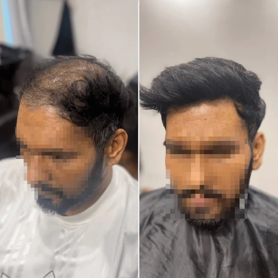 A Topee client before and after a hair system fitting