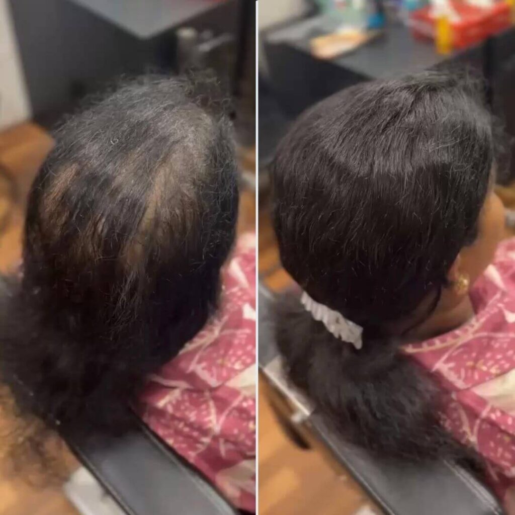 hair patch in bangalore