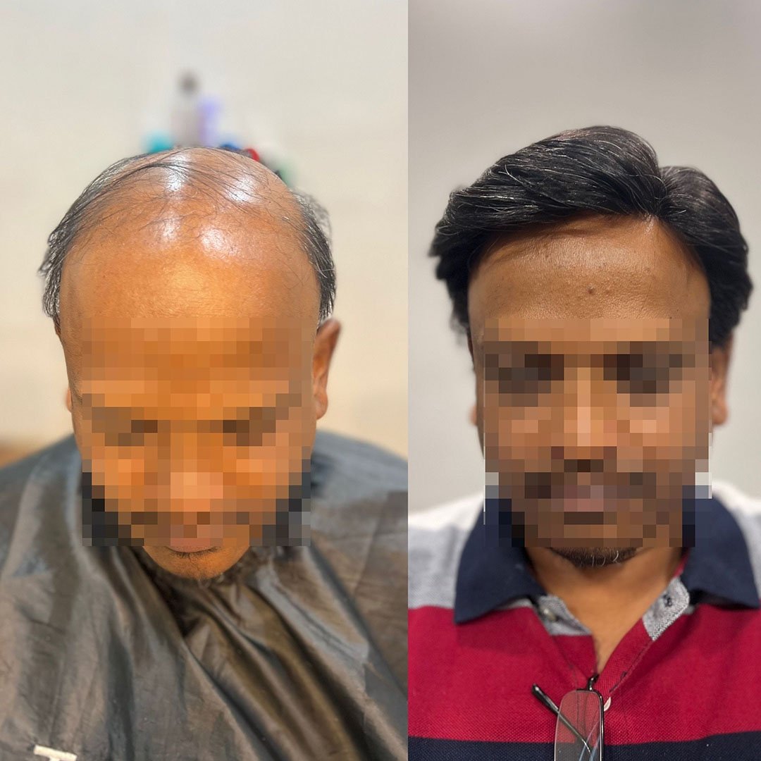 Before and after results of hair wigs for men in Bangalore