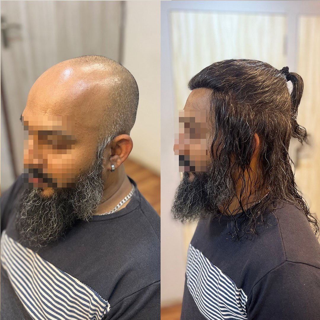 Before and after results of hair wigs for men in Bangalore 2
